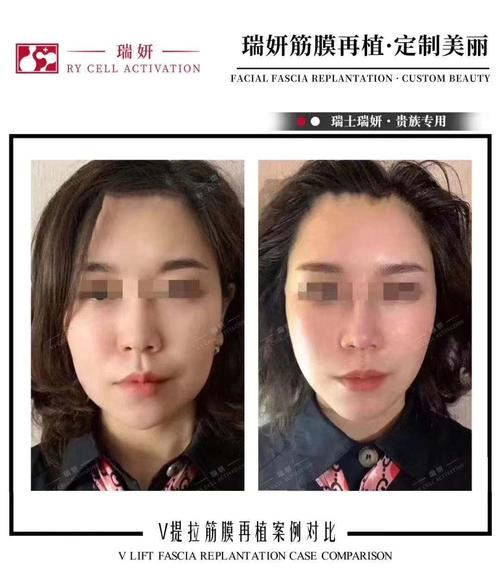 瑞士瑞妍筋膜再植品牌优势,筋膜再植提升激活全脸抗衰