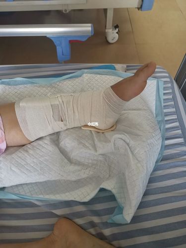 骨折记录_消肿_医疗健康_医疗健康其他