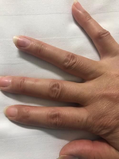 甲下血管球瘤
