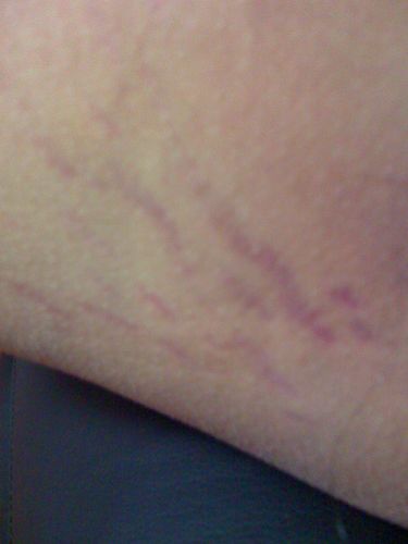 大腿内侧有一条条的紫斑