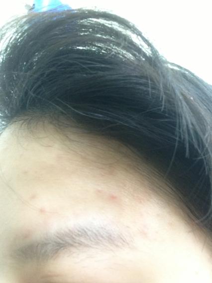 但是我脸上从来不长痘痘的!都一个星期了!感觉越来越严重了
