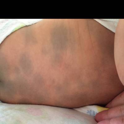 臀部,四肢或头部出现大小不等,形态各异的青色斑块,俗名青记,或胎记