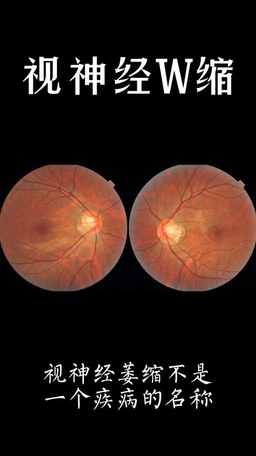不一样的人生视神经萎缩指的是什么呢