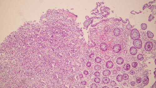 但是,总有那么一点感觉不对劲,我写了会诊意见:结肠腺癌.