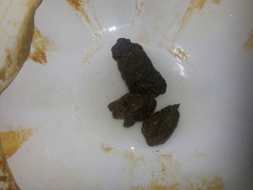 得直肠癌便血已五个月的图片