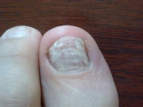 临床上将灰指甲分为2种类型 一种是 菌性白甲 因为真菌未深入至甲内