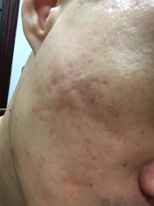 这个增生疤痕如何处理?还有右侧痘印,求好心的楼.