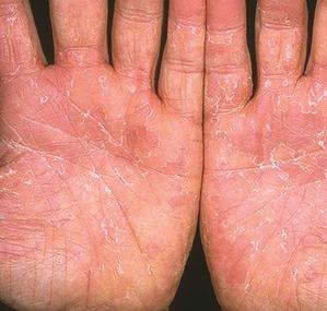 剥脱性角质松解症是一种浅表的手足角质剥脱性皮肤病,好发于双侧掌跖