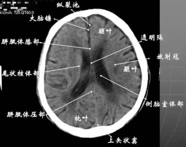 7 大脑皮质下部层面(半卵圆中心层面) 在胼胝体和侧脑室上方,大脑镰