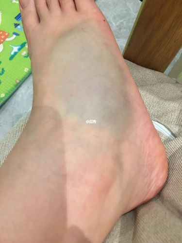 脚扭骨折了_骨折_医疗健康_医疗健康其他