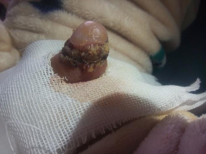 包茎手术第五天孩子是不是有炎症