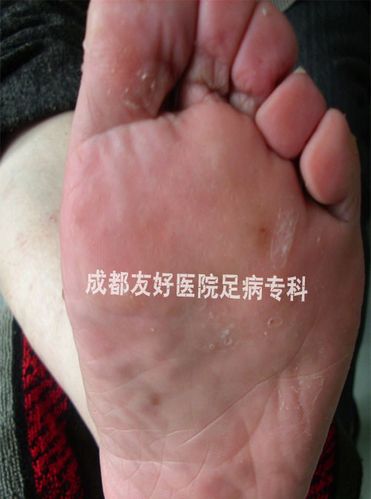 [转载]脚垫,老茧 治疗方法