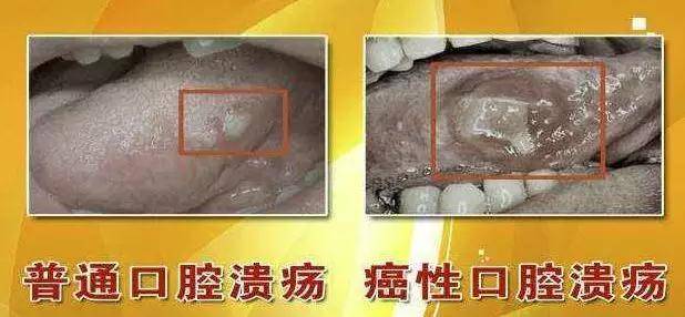 是的,口腔溃疡可以是全身疾病的临床表现之一,比如白塞病,克罗恩病