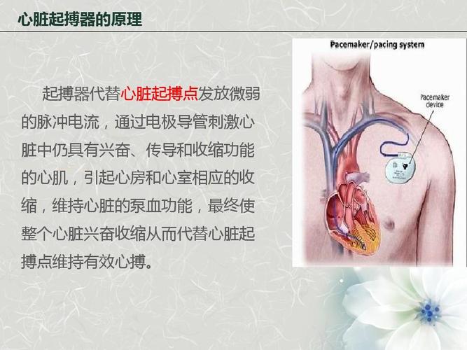 心脏起搏器植入术后护理ppt