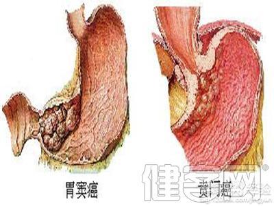 造成贲门癌的主要原因是什么