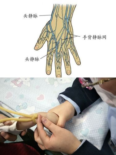 我们首选手背静脉,易固定,因孩子活动度大,尽量避免穿刺手腕部
