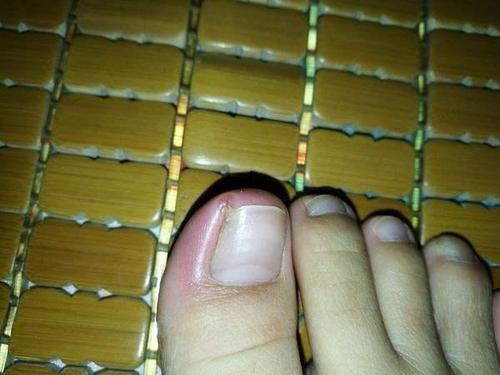 指甲长进肉里,或许是甲沟炎,试试这4个办法,轻松应对无烦恼