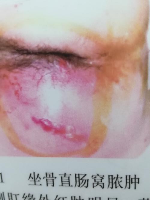 肛裂,肛瘘,肛周脓肿,肛门瘙痒症,肛窦炎,直肠炎,结肠炎,直肠溃疡,出口