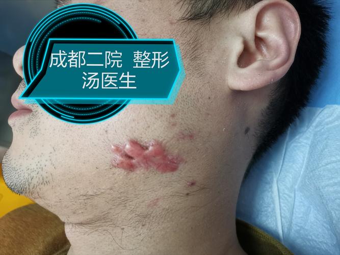 患者因青春痘感染,局部反复破溃,最后疤痕增生