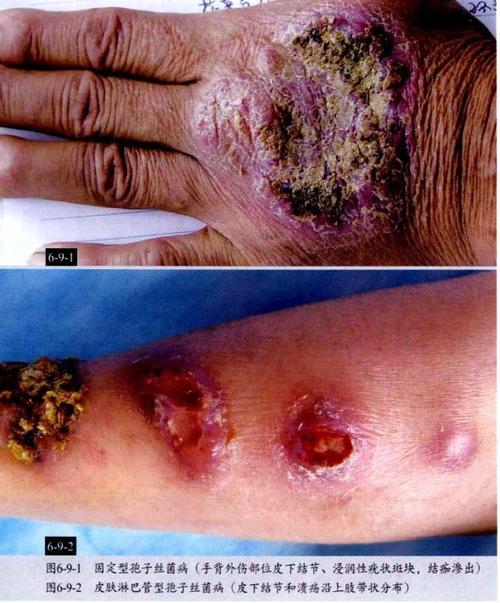 皮肤结核15蜂窝织炎14疖13毛囊炎12丹毒11葡萄球菌性烫伤样皮肤综合征