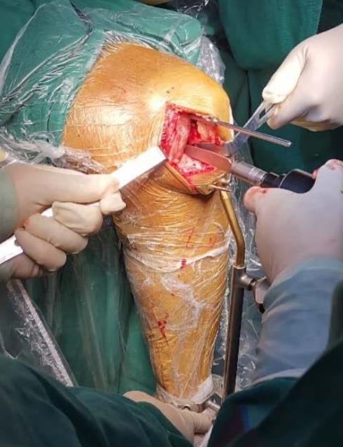 于胫骨内侧髁间棘内侧矢状位截骨