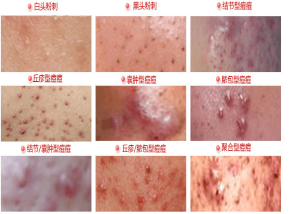 痤疮的种类Ⅳ级:结节或囊肿性痤疮,聚合性痤疮,总病灶数超过100个