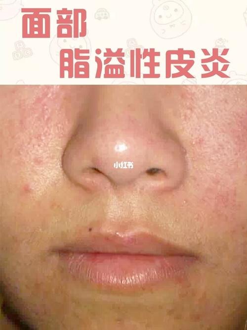 面部脂溢性皮炎_皮炎_药膏_红疹_草本_医用面膜_脂溢性皮炎_医疗健康