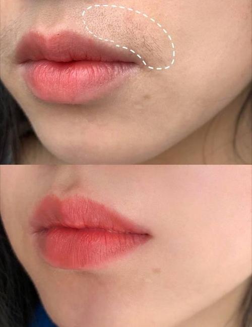 为何有的女生唇边长小胡子唇毛的多少与什么因素有关