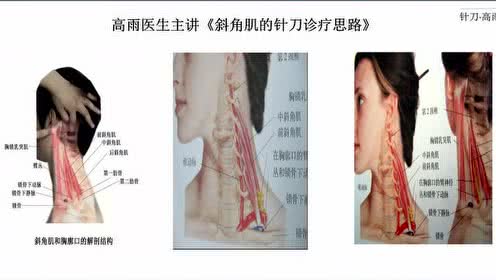 高雨医生主讲《斜角肌损伤的针刀诊疗思路》