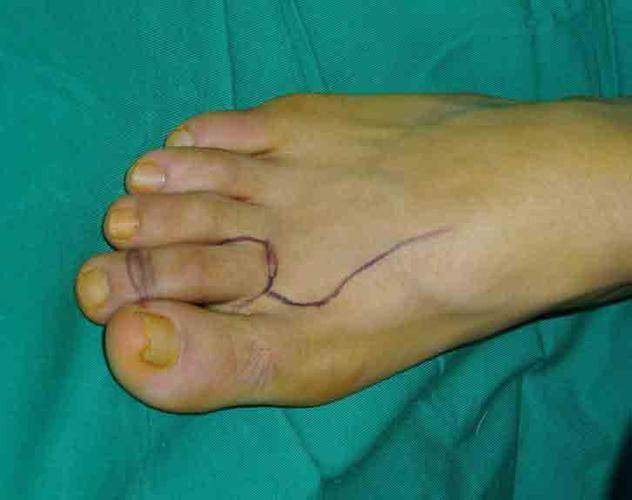 第二足趾节段复合组织瓣移植术
