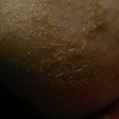 宝宝头上的是脂溢性湿疹吗?有图