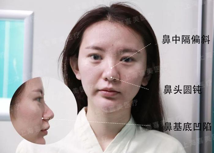 面诊情况:鼻中隔偏曲,鼻头圆钝,鼻基底凹陷 手术方案:取鼻中隔做鼻头