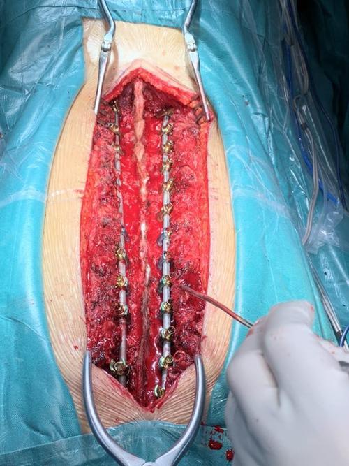 宁夏医科大学总医院骨三科完成青少年特发性脊柱侧弯矫形手术治疗