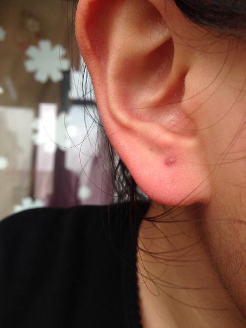 耳洞发炎长死后表面有个小硬疙瘩,正常吗,要不要紧,多久会消,这个