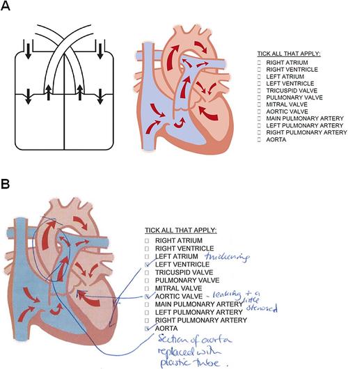 patient-specific models of congenital heart defects for