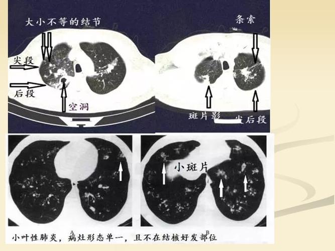 肺结核影像学ct精华版