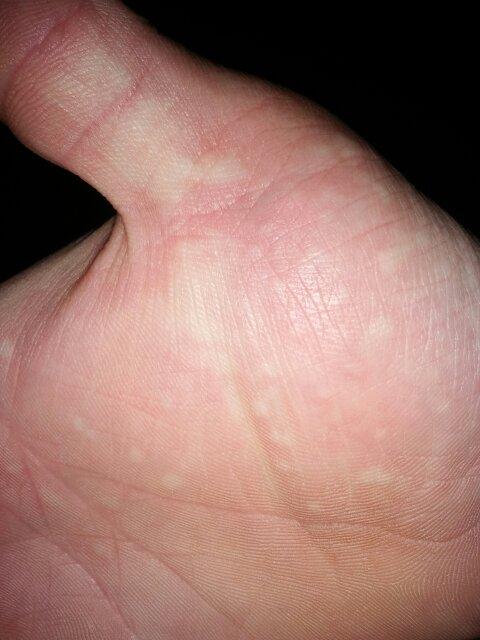 每晚睡觉时,都痒,挠挠以后就会出现