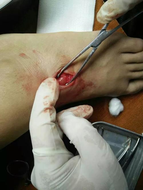 我脚背上的腱鞘囊肿动了手术才二个月又长了该怎么办