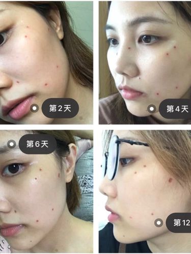 [激光点痣]激光点痣一年后怎么样了?