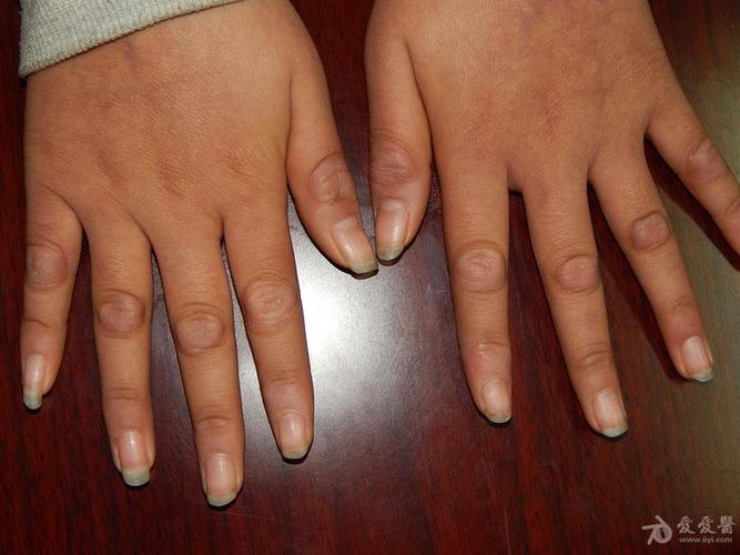 小女孩的手——指节垫