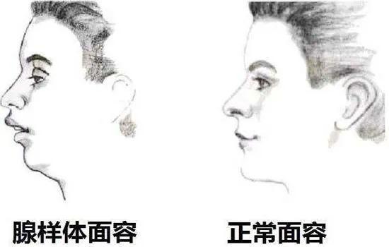 你知道吗孩子张嘴睡觉可能是种病会变丑的病