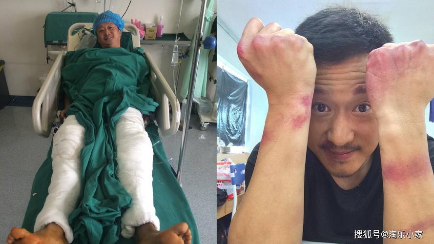 网友制作吴京全身受伤图超震撼,缝针高达100多针,可领