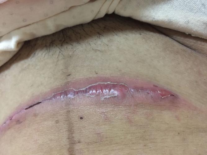 剖腹产15天了,伤口有点红肿脱皮,是不是里面发炎了.