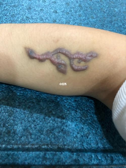 洗纹身增生_纹身_美妆_医美整形