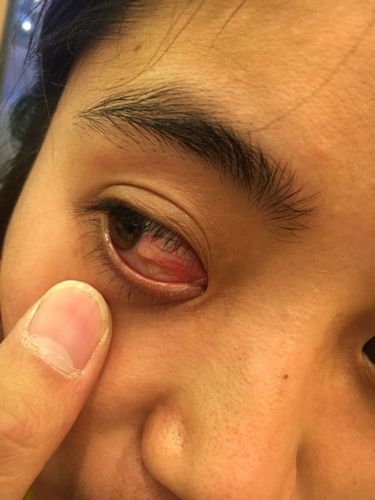 眼科,眼角膜发炎