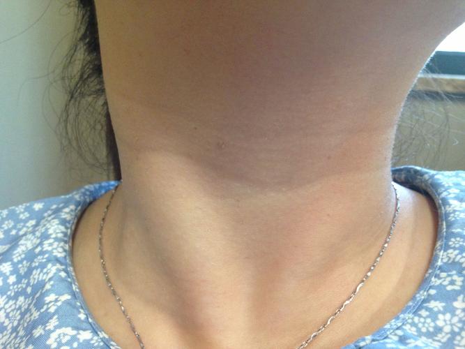 脖子上的皮肤长了这个小点点,不知道是什么?