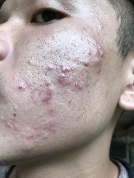 脸上长好多脓包