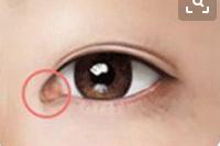 泪阜就是眼角处呈卵圆形,隆起的那部分红色组织 有些人因为内眦赘