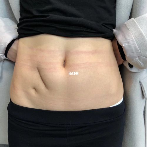 阑尾炎疤痕纹身遮盖_疤痕_纹身_纹身也清新_美妆_彩妆