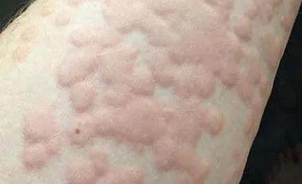 荨麻疹是一种常见的瘙痒性过敏性皮肤病.